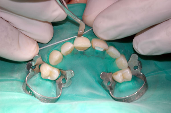 Ceras Dentales: Tipos y Usos | Clasificación de Ceras