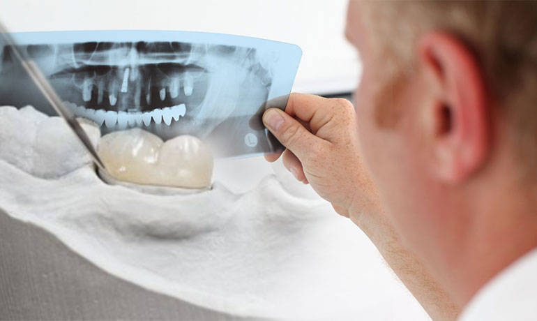 Reconstrucción dental: cómo se hace, técnicas, durabilidad y costos