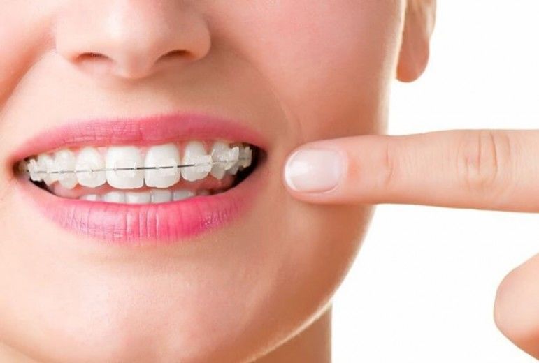 Ortodoncia: Cómo cepillarse los dientes y usar hilo dental con brackets