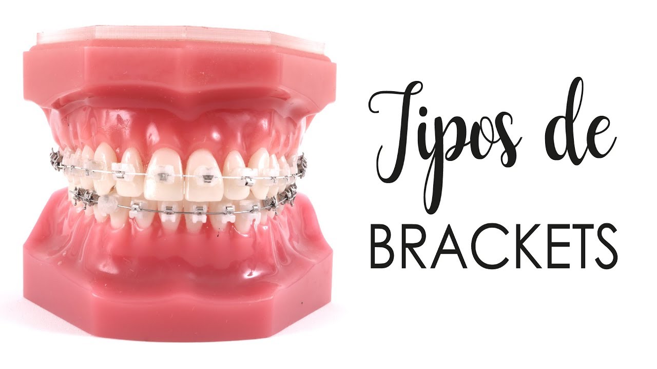 Tipos De Brackets: ¿Cómo saber cuáles son los brackets ideales para ti?