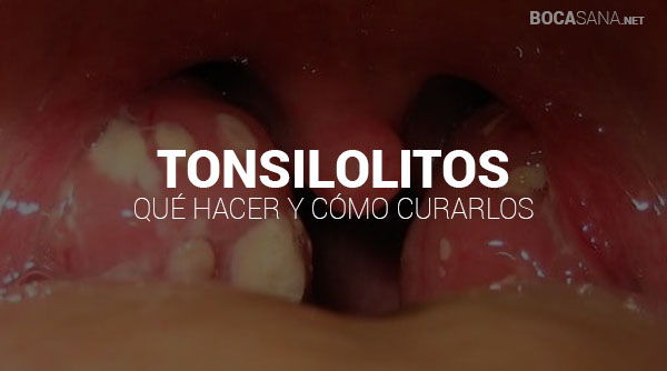 Tonsilolitos ¿Qué son? Causas y tratamientos