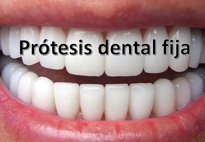 Prótesis dental fija: Tipos, ventajas y desventajas