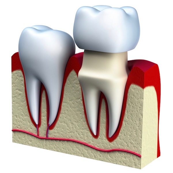 Corona dental: qué es y cuando se necesita