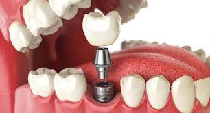 ¿En qué consiste el tratamiento con implantes dentales? ¿Cuánto cuesta y cómo se hace?