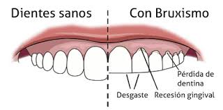 Bruxismo y cómo las nuevas tecnologías en la odontología están  ayudando en los tratamientos